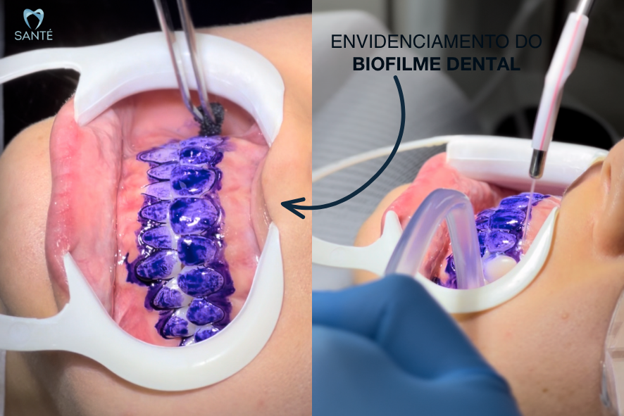 Evidenciação de biofilme dental com aplicação de corante roxo para guiar com precisão a limpeza dentária em BH na Santé Odontologia.