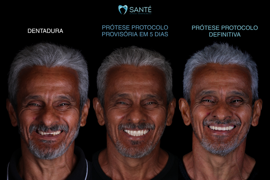 Sequência de fotos de paciente em BH: primeiro com dentadura, depois com prótese provisória em 5 dias e o resultado final com a definitiva.