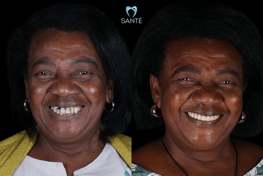 Antes e depois de paciente com dentadura superior frouxa em BH, mostrando a renovação do sorriso com prótese fixa.