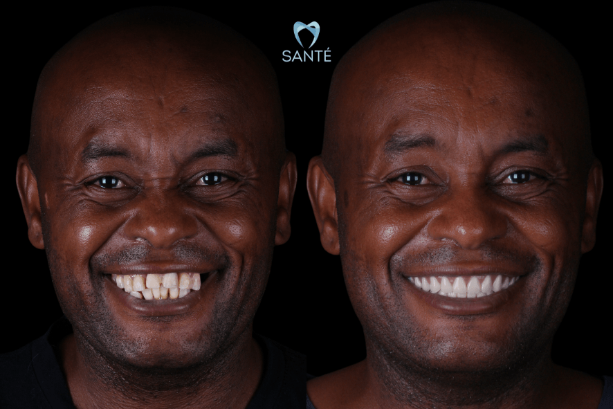 Antes e depois de paciente que trocou dentadura por prótese protocolo fixa em BH. À esquerda dentes desgastados e à direita sorriso renovado.