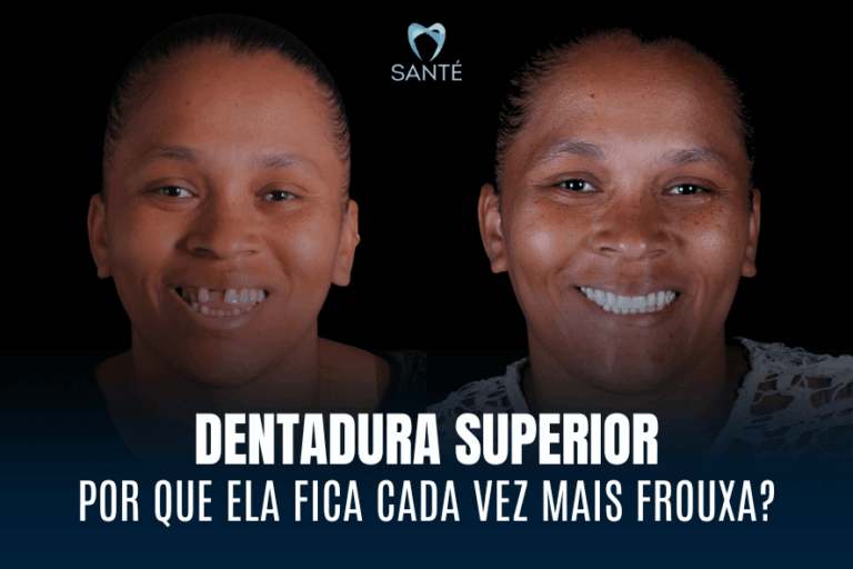 Antes e depois de paciente com dentadura superior frouxa em BH, mostrando a renovação do sorriso com prótese fixa.