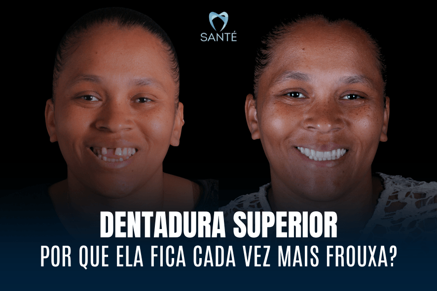 Antes e depois de paciente com dentadura superior frouxa em BH, mostrando a renovação do sorriso com prótese fixa.