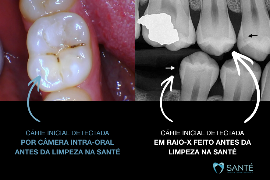 Exame com câmera intraoral e raio-X detectando cárie inicial antes da limpeza dentária em BH na clínica Santé Odontologia.