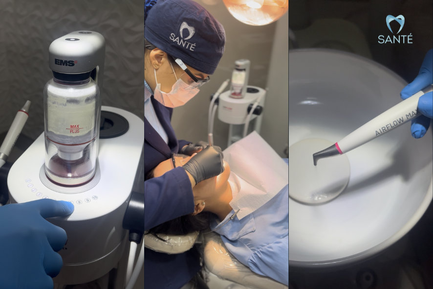 Dentista realiza a moderna limpeza dos dentes em Belo Horizonte utilizando o equipamento tecnológico Airflow na Santé Odontologia.