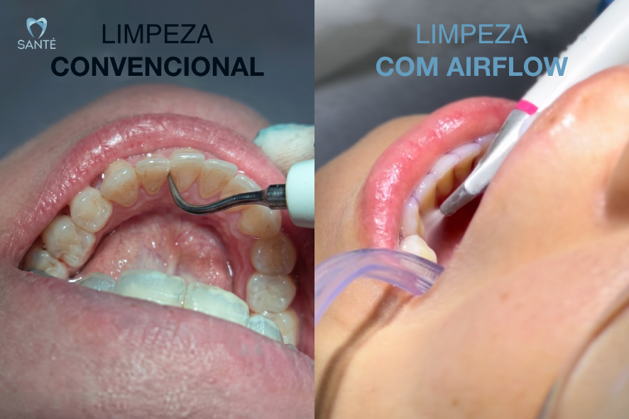Comparativo visual entre raspagem convencional e a moderna limpeza dentária com Airflow na Santé Odontologia em Belo Horizonte.