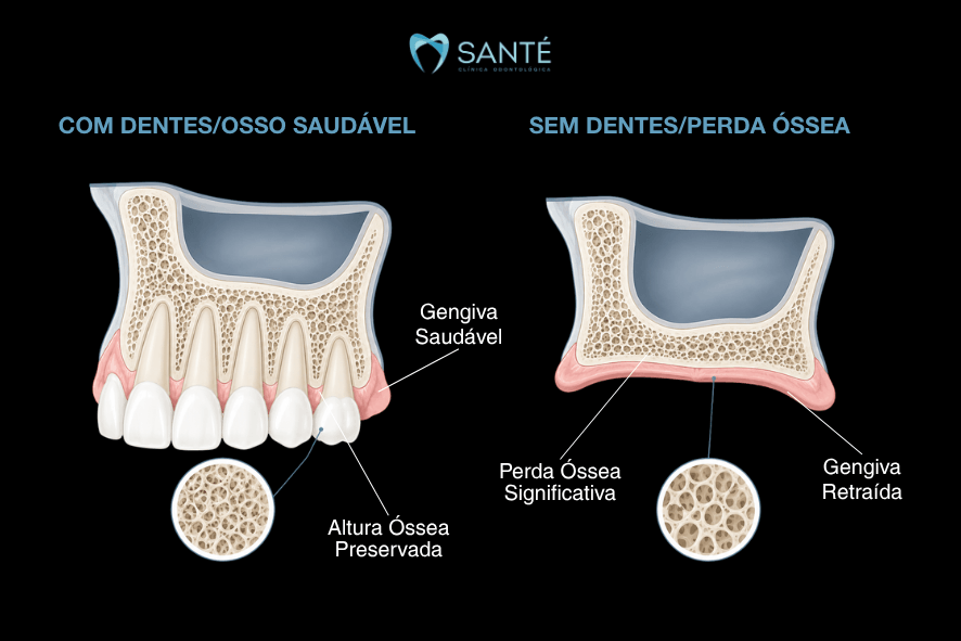 Diagrama comparativo entre osso saudável e perda óssea significativa causada pelo uso prolongado de dentadura frouxa.
