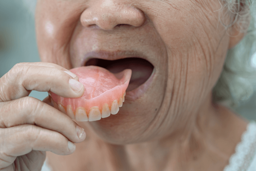 Paciente idosa colocando dentadura superior, ilustrando o uso de pastas fixadoras como Corega ou Fixodent.