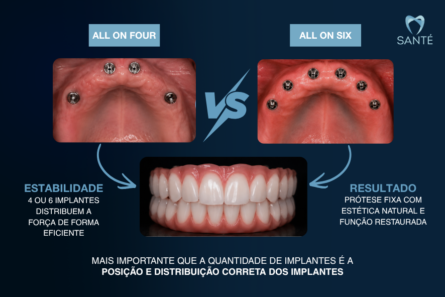 Infográfico comparando técnicas all on four e all on six de prótese protocolo na clínica odontológica Santé em Belo Horizonte.