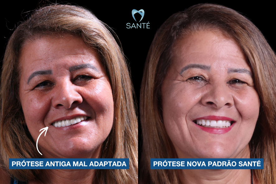 Antes e depois de paciente comparando prótese protocolo antiga mal adaptada com a nova prótese dentária fixa em Belo Horizonte.
