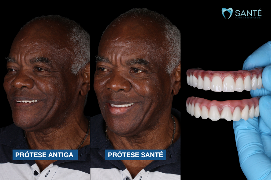 Homem sorri após trocar prótese protocolo quebrada por nova prótese dentária fixa de resina tripla prensagem na Santé em Belo Horizonte.