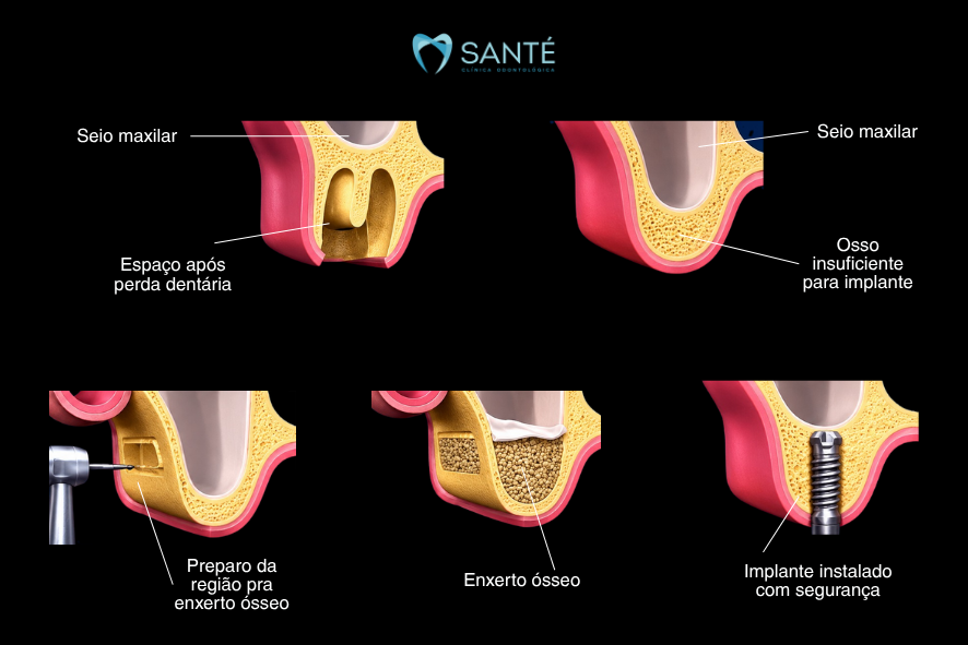 Diagrama de levantamento de seio maxilar e enxerto ósseo para implantes dentários após perda de osso na clínica Santé em Belo Horizonte.