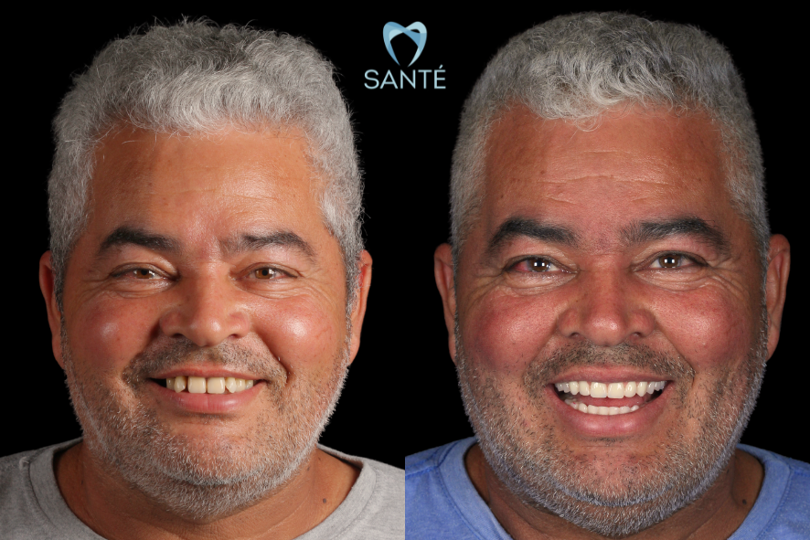Antes e depois completo da transformação do sorriso masculino com prótese protocolo realizada na clínica Santé em Belo Horizonte