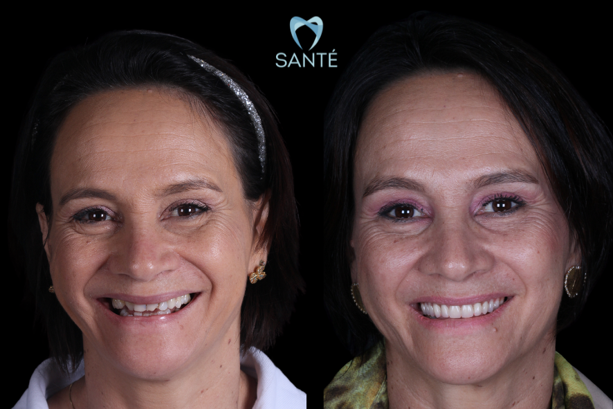 Antes e depois de reabilitação oral feminina com prótese protocolo superior na clínica odontológica Santé em Belo Horizonte