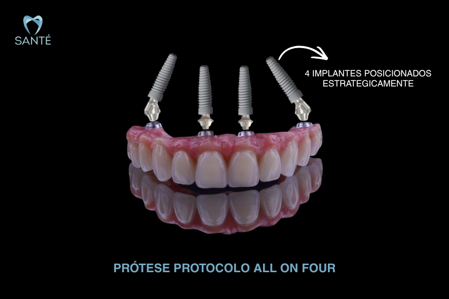 Modelo digital de prótese protocolo all on four mostrando quatro implantes dentários fixados estrategicamente na arcada em Belo Horizonte.