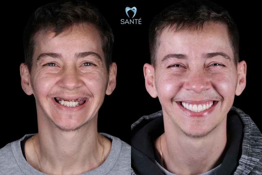 Transformação completa de sorriso masculino utilizando prótese protocolo com dentes de tripla prensagem na Santé em Belo Horizonte