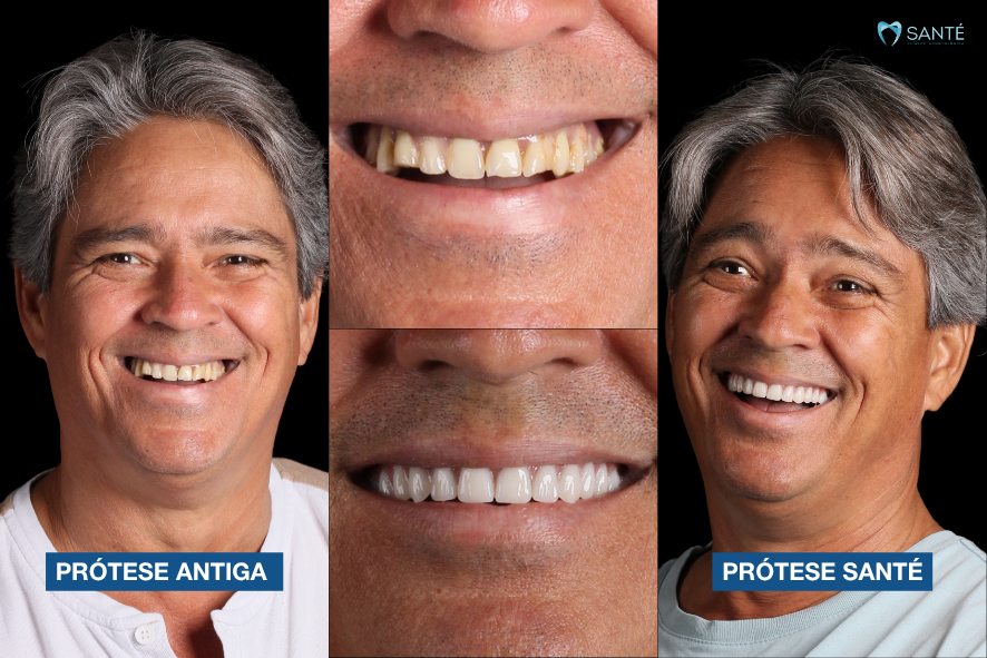 Antes e depois de paciente em Belo Horizonte mostrando a troca de prótese antiga por protocolo Santé com dentes de tripla prensagem.