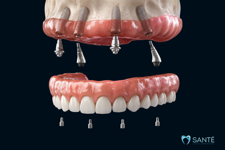 Vista explodida em 3D demonstrando a fixação dos implantes e parafusos da prótese protocolo na clínica Santé em Belo Horizonte
