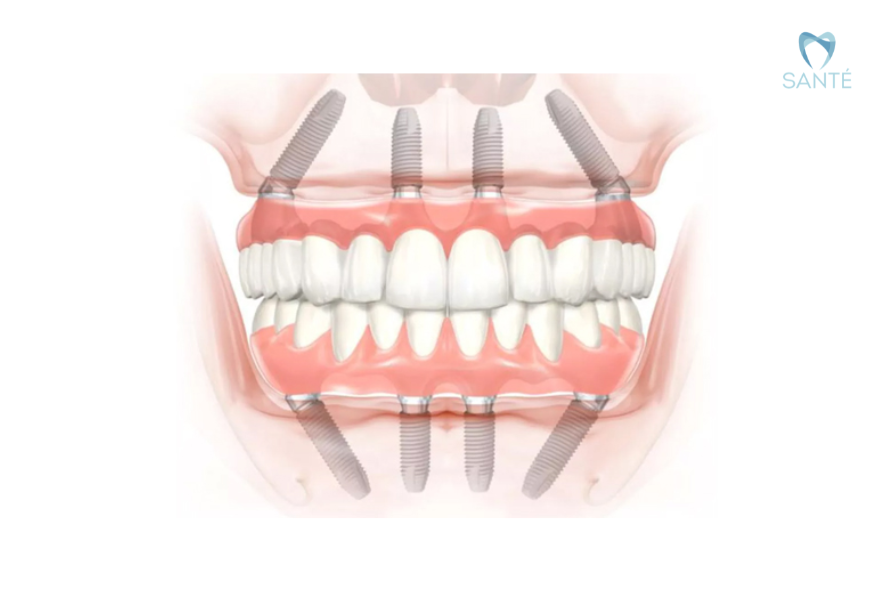 Ilustração anatômica de implantes angulados para protocolo de carga imediata nos maxilares na clínica Santé em Belo Horizonte