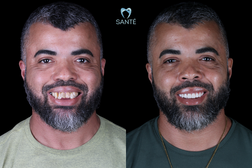 Transformação do sorriso de homem com barba após tratamento de prótese protocolo sobre 4 implantes na Clínica Santé em Belo Horizonte.