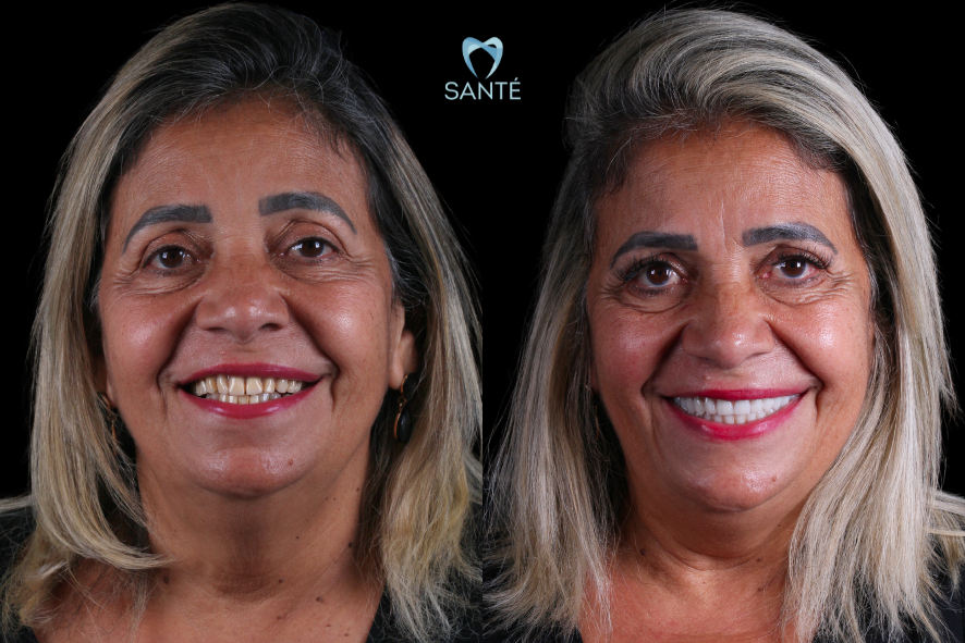 Paciente exibe antes e depois de tratamento para descobrir quanto custa a prótese protocolo com materiais de qualidade em Belo Horizonte.
