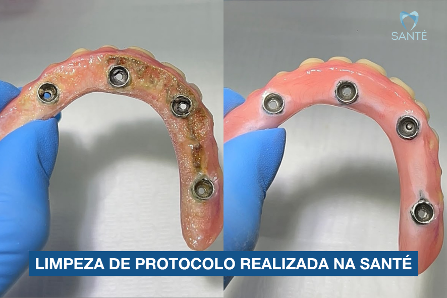 Comparativo da parte interna da prótese protocolo antes e depois da limpeza profissional realizada em consultório em Belo Horizonte.