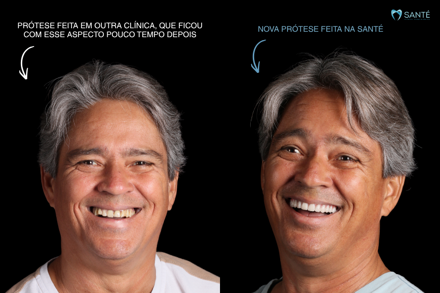Comparativo de prótese protocolo antiga de baixa qualidade versus a nova prótese natural feita na clínica Santé em Belo Horizonte