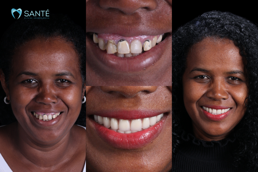 Antes e depois de prótese protocolo para perda óssea dentária na Clínica Santé em Belo Horizonte, mostrando a transformação do sorriso.