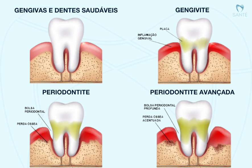Infográfico explicativo sobre evolução da doença periodontal e perda óssea dentária, do dente saudável à periodontite avançada em BH.