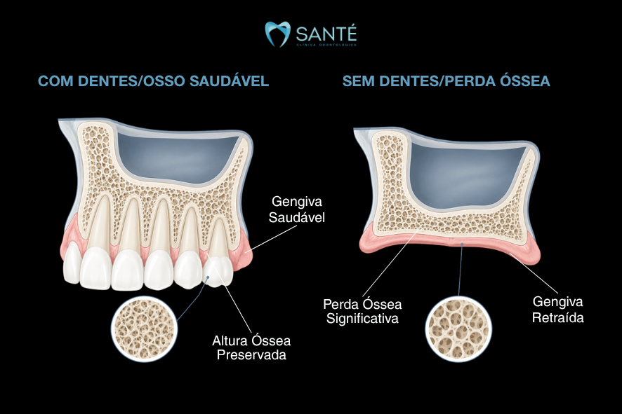 Comparativo gráfico entre dentes com osso saudável e arcada com perda óssea significativa e gengiva retraída, em Belo Horizonte.