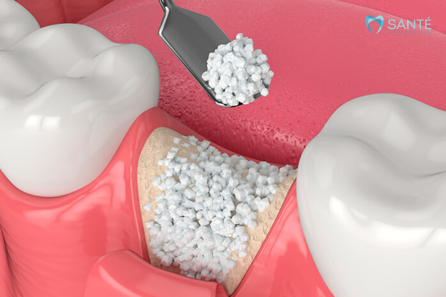 Ilustração em 3D de preenchimento alveolar com enxerto ósseo dentário para preservar o osso após perda de dente em Belo Horizonte.