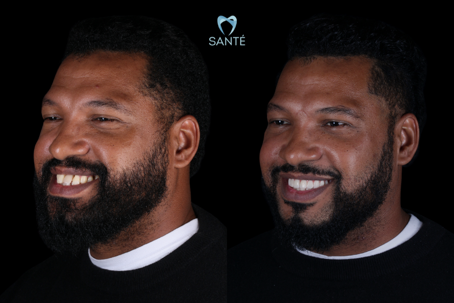 antes e depois protese protocolo parcelada
