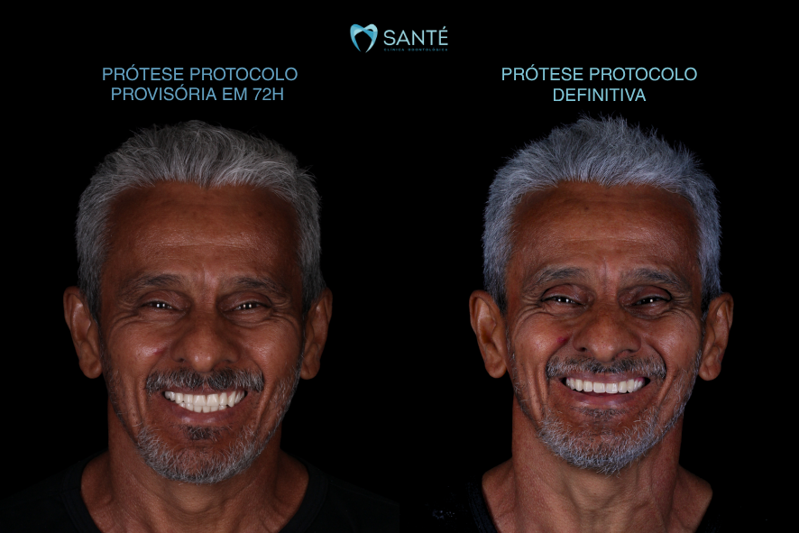 protese protocolo em 72 horas e 3 dias