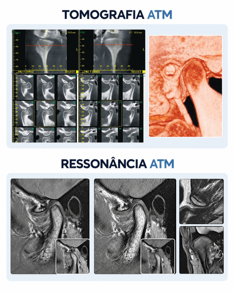 Ressonância atm e tomografia atm