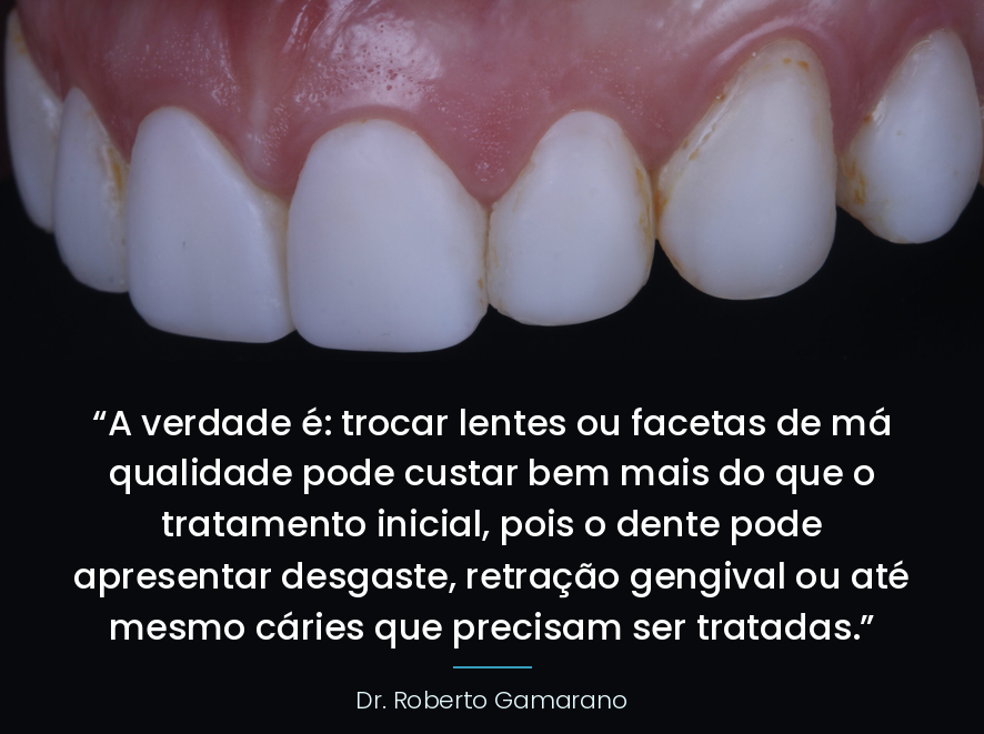 Como tirar mancha faceta resina com machamento