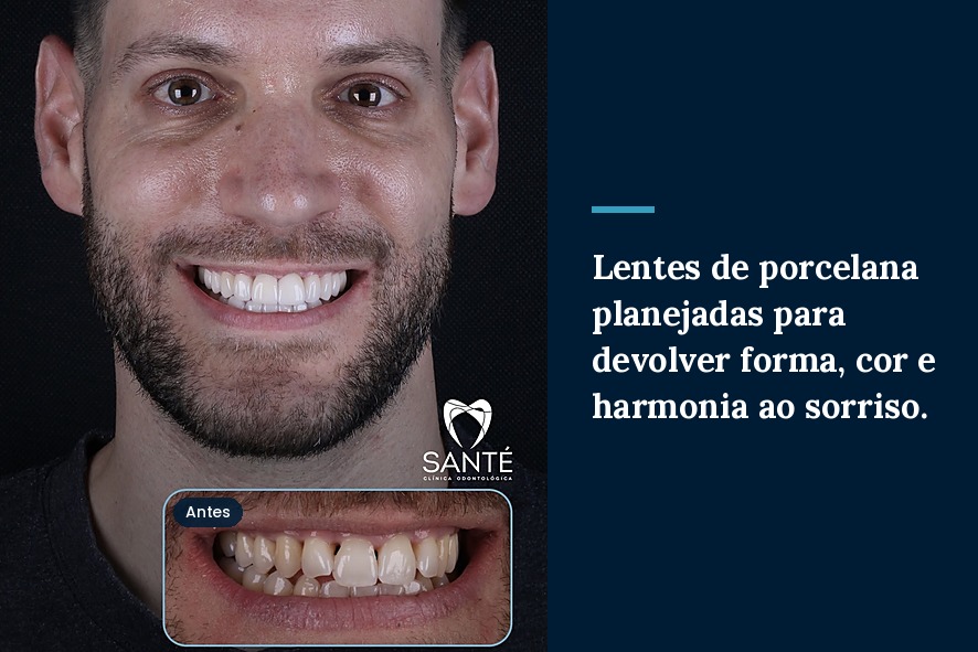 antes e depois lente de porcelana em belo horizonte_