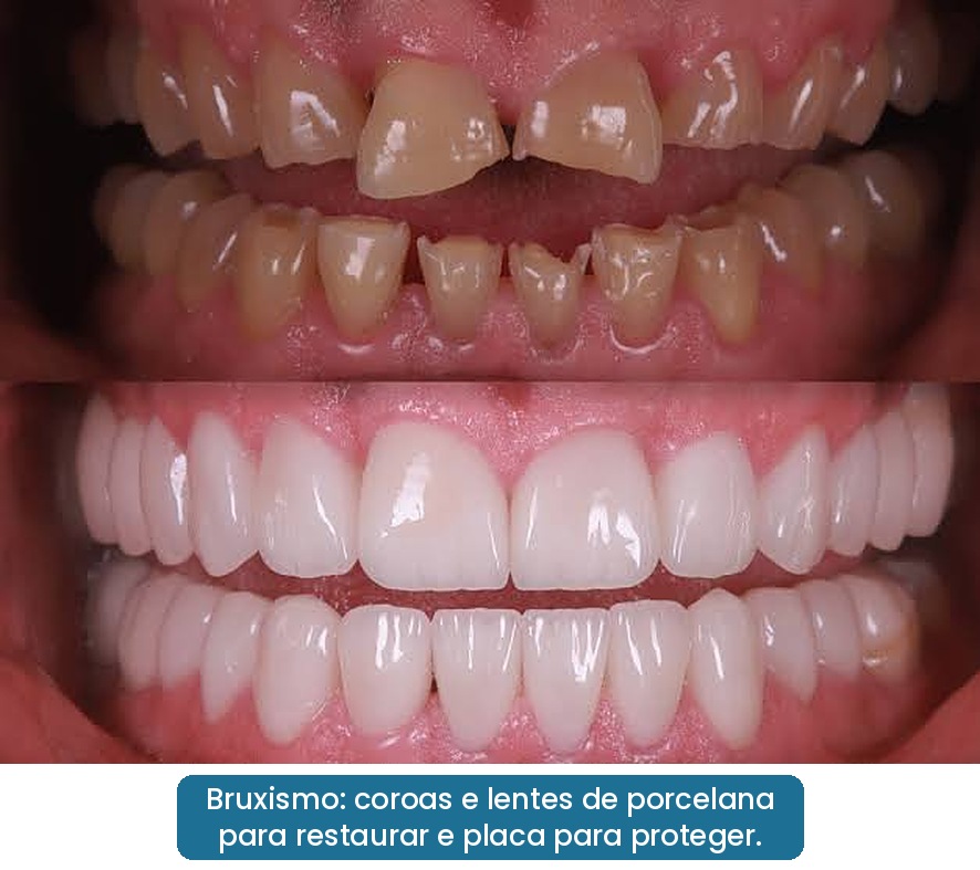 facetas e lentes de porcelana em paciente com bruxismo