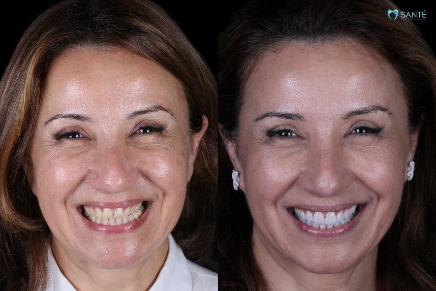 antes e depois de lentes de porcelana em paciente da Santé em Belo Horizonte
