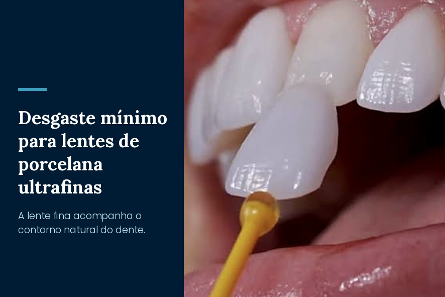 lente de porcelana sem desgaste em bh belo horizonte