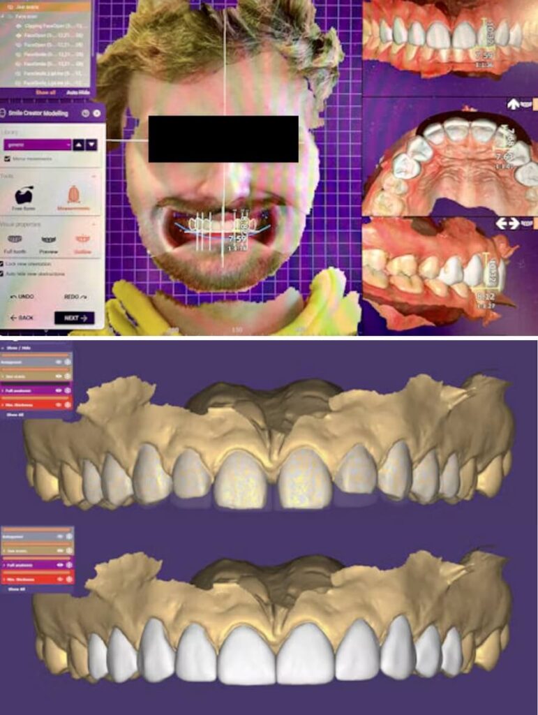 lentes de porcelana emax e zirconia fluxo digital