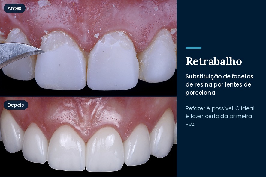 troca de facetas de resina por lentes de porcelana qual é melhor
